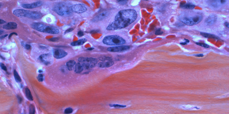 the picture shows cancer cells