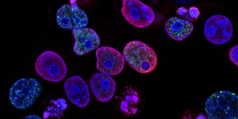 Purple cancer cells under a microscope. ‘Jess’s Rule’: new GP initiative to prevent avoidable patient harm